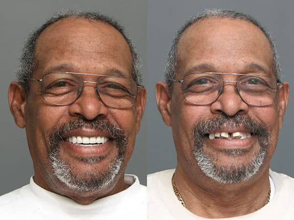 A patient's before-and-after image, showing the difference in his teeth after dental procedures in Towson. His after picture, shown on the left, shows that his teeth are much straighter than before.